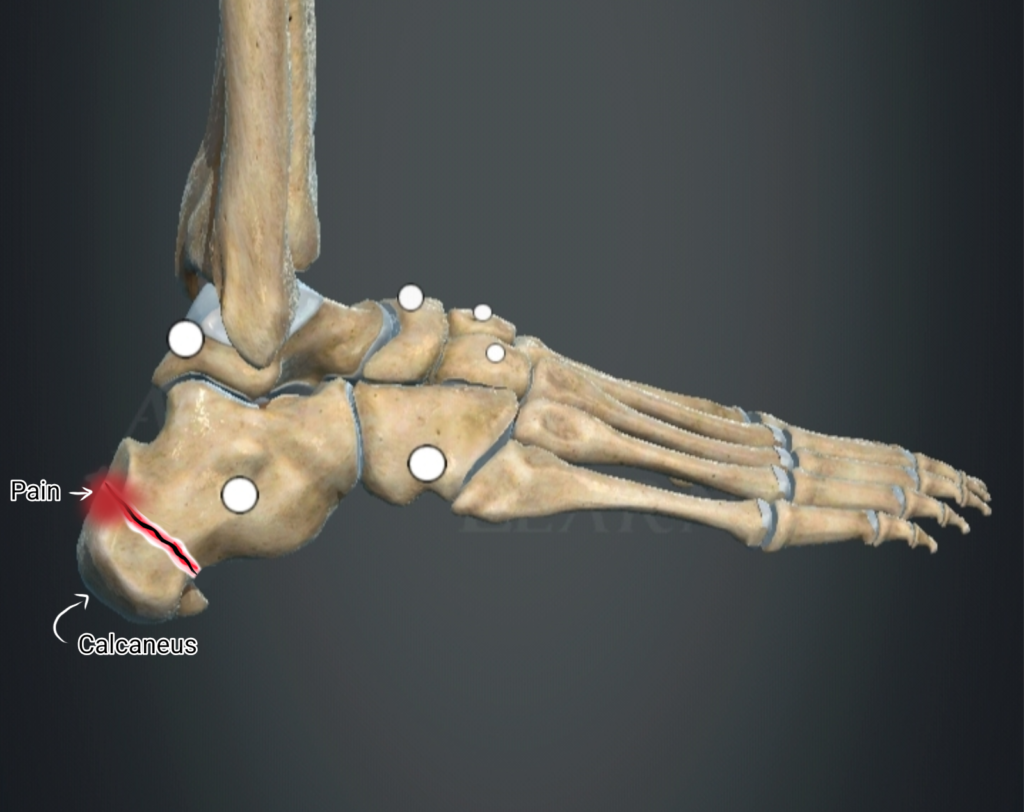 My Heel Hurts When I Walk β Sever Disease?