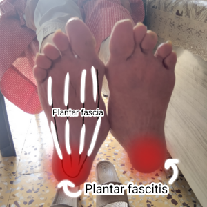 My Heel Hurts When I Walk β Plantar Fasciitis