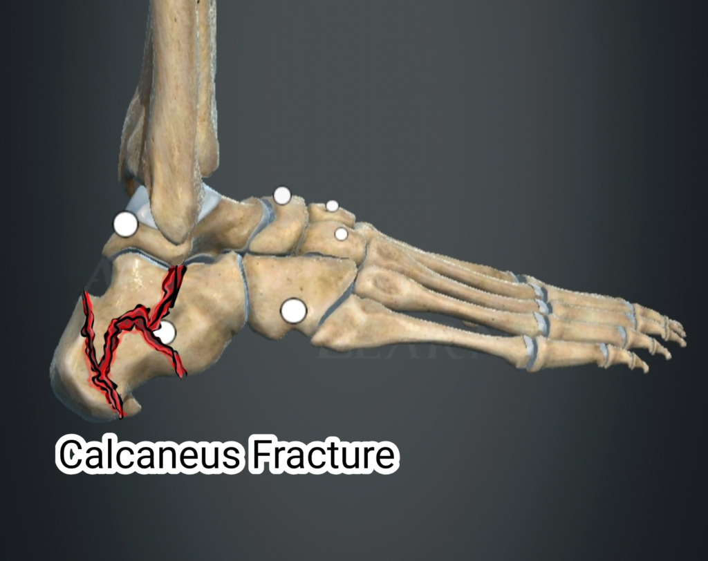 My Heel Hurts When I Walk β Calcaneus Fracture